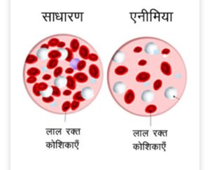 एनीमिया के कारण एवं रोकथाम