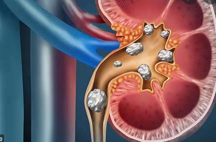 पथरी का उपचार आब घर बैठे जानिए क्या है इसका सटीक इलाज ।