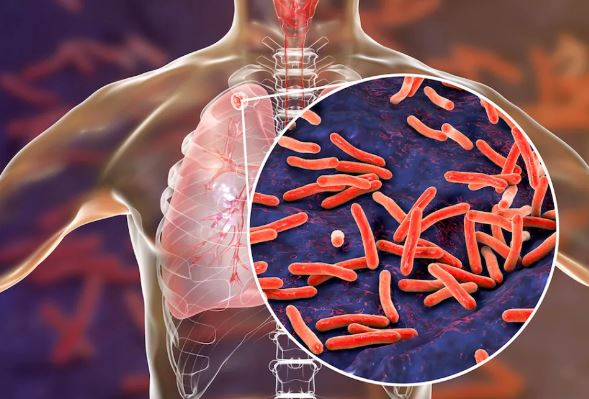 Tuberculosis Treatment 1 तपेदिक