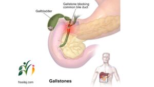 Gallstones